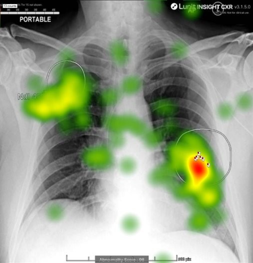 PGR Voices: Understanding human-AI interaction in medical imaging: Moving towards ‘appropriate reliance’